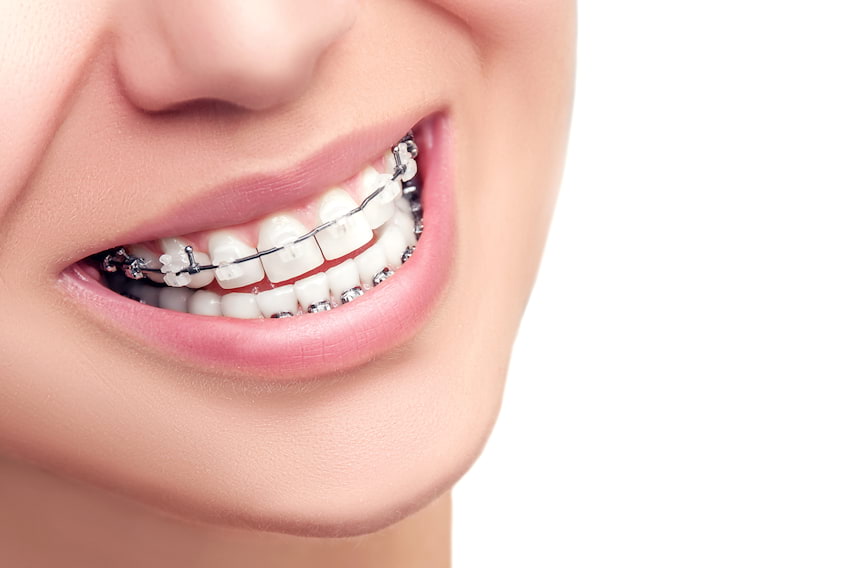Piękny uśmiech - dla kogo aparat ortodontyczny?